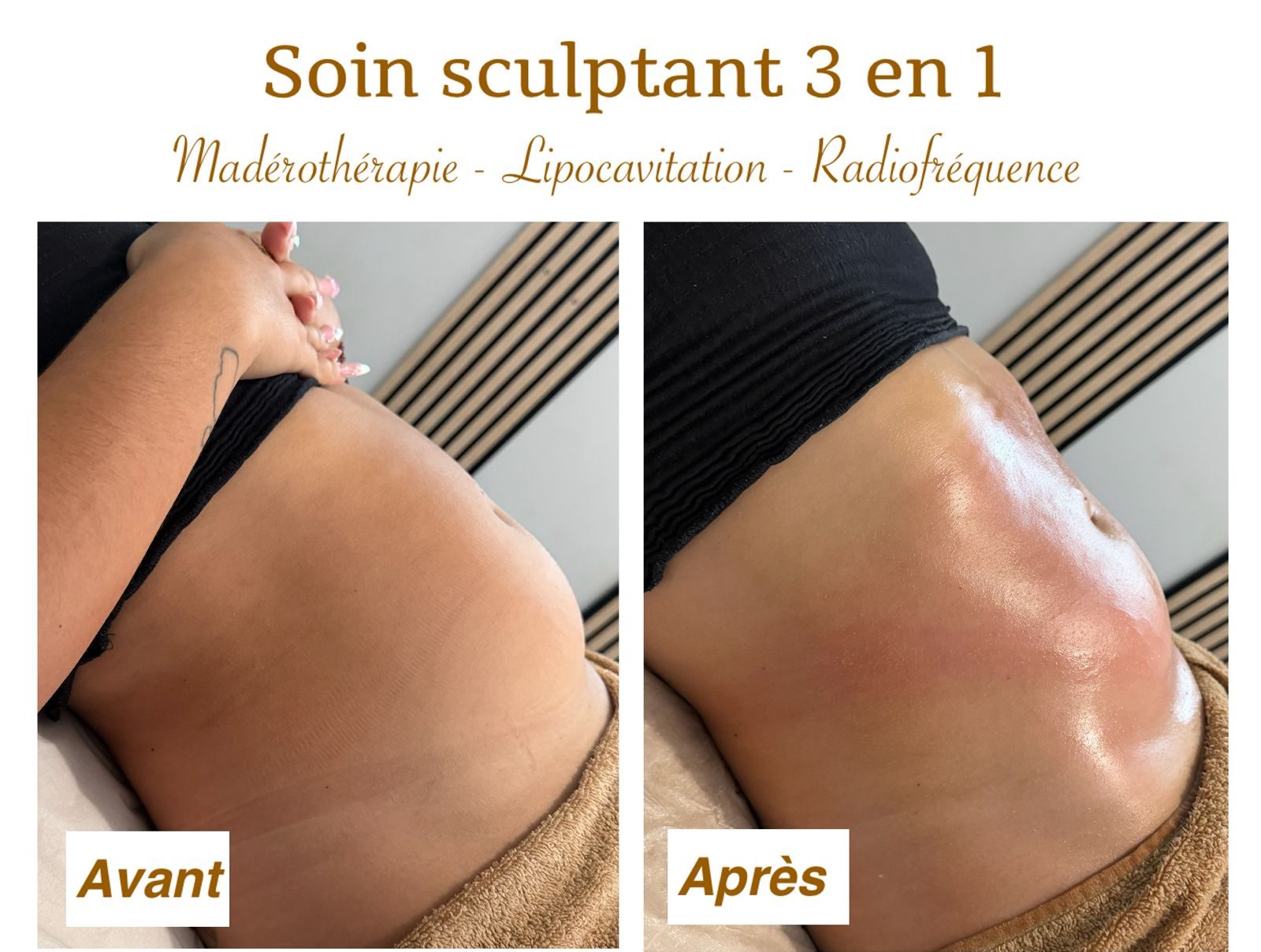 SOIN SCULPTANT 3 EN 1 (lipocavitation, radiofréquence)